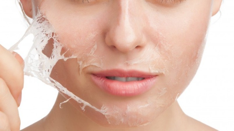 woman getting chemical peel