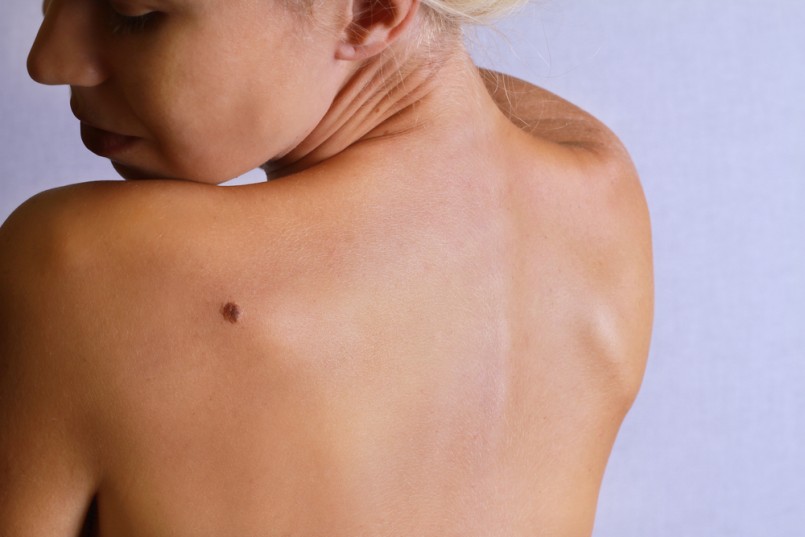 Young woman looking at birthmark on her back, skin. Checking benign moles. Skin tags removal